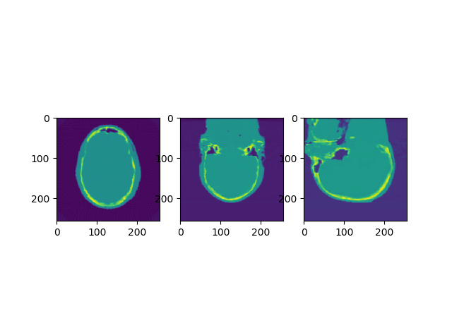 pythonとTIGREを使ったコーンビームCT（CBCT）の再構成 #Python - Qiita